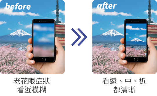 什麼是LEX全視清老花雷射